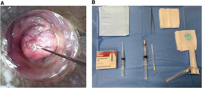 Results of sclerotherapy and mucopexy with haemorrhoidal dearterialization in II and III degree haemorrhoids. A 4 years' single centre experience